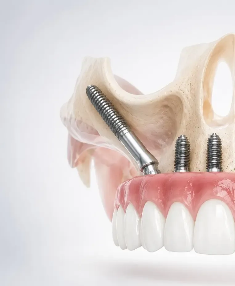 implantes cigomaticos barcelona clinica nacar - ¿Te han dicho que no puedes ponerte implantes por falta de hueso?