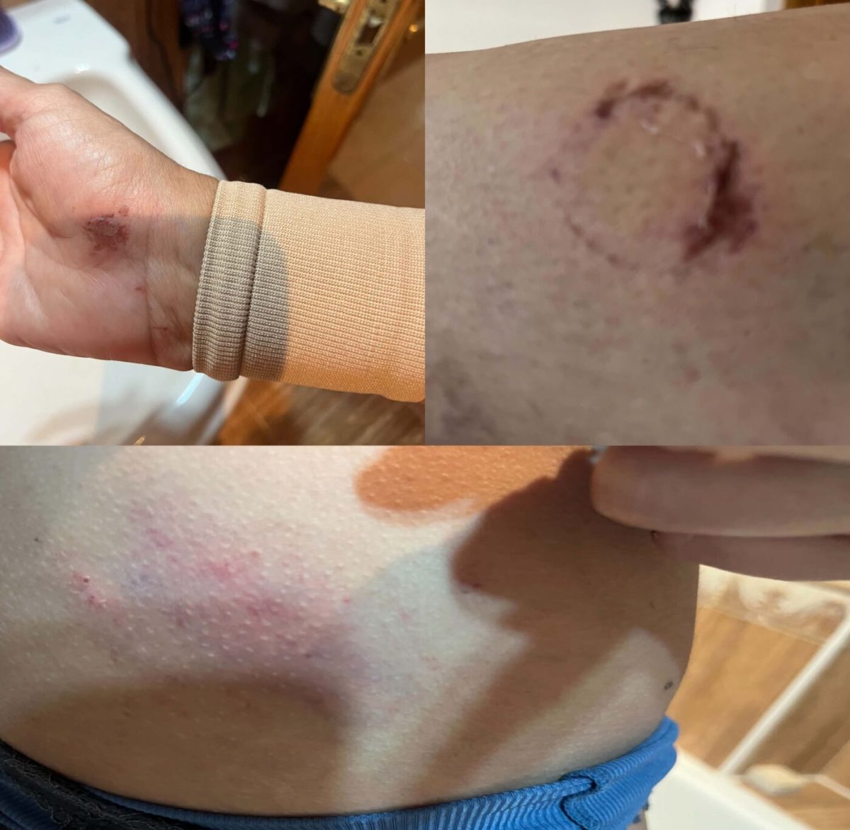 Heridas fruto de la agresión a una mujer mayor en La Gangosa. /DC