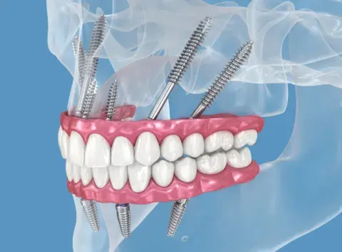 Implantes cigomáticos